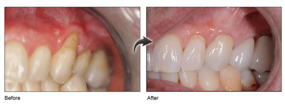 south-florida-gum-recession-surgery-treatment-dentist