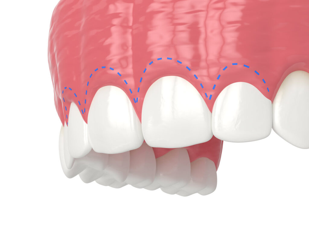 3d render of upper jaw with gummy smile and corrected gum line.