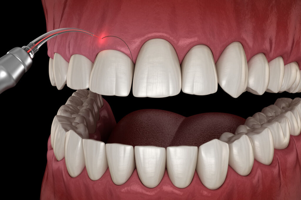 Gingivectomy surgery with laser using. Medically accurate tooth 3D illustration